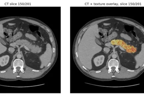 AI finds signs of pancreatic cancer before tumors develop